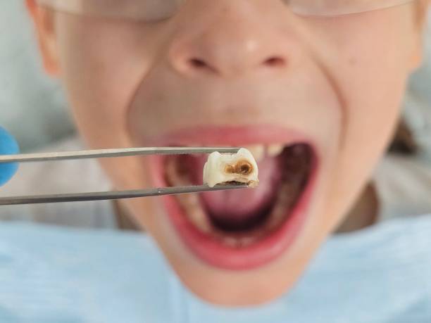 Best Emergency Tooth Extraction in Kimberly, AL